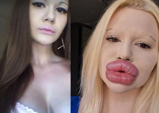 Ella es la mujer con labios más grandes del mundo… y quiere aumentarlos más